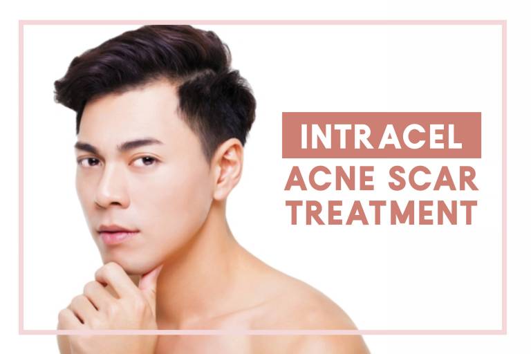 lux medical aesthetic clinic intracel acne scar treatment in singapore