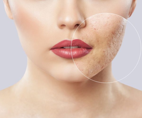 Can Dermal Fillers Help Your Acne Scars? Top 5 Things You Must Know