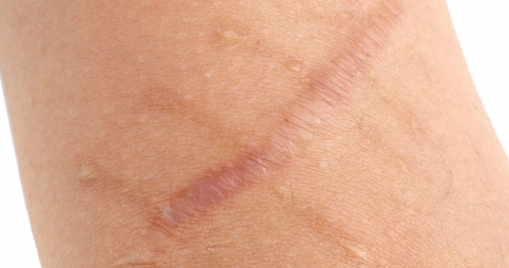 close up on scar
