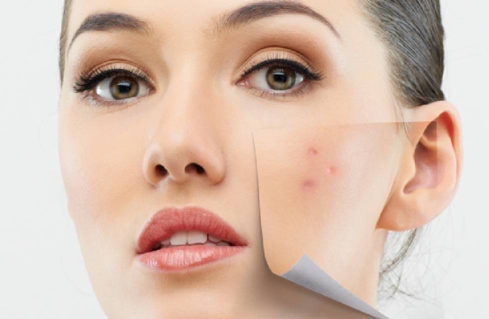 Is Laser Therapy Effective for Acne Scar Removal?