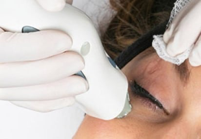 thermage eye treatments