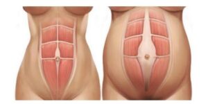 diastasis rect