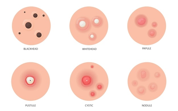 Different types of acne flat set