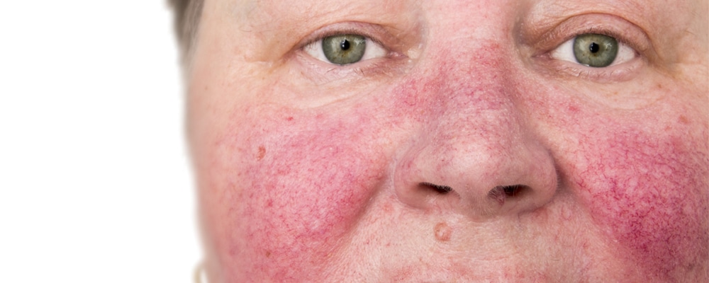Face of man with Rosacea