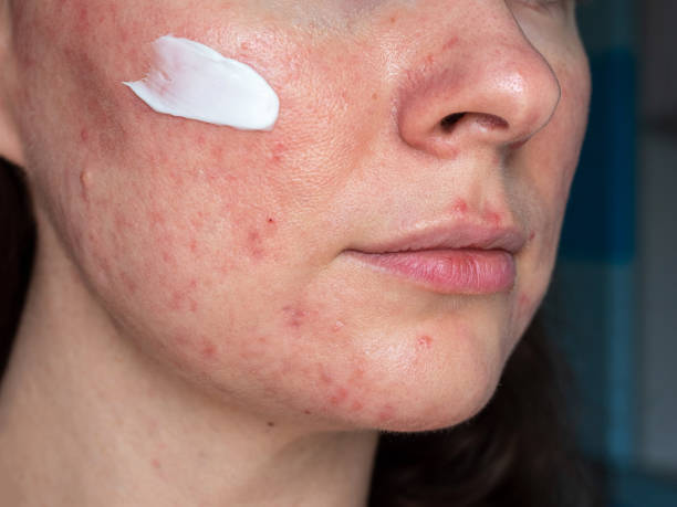 Medicated ointment on woman face with rosacea close up stock photo...