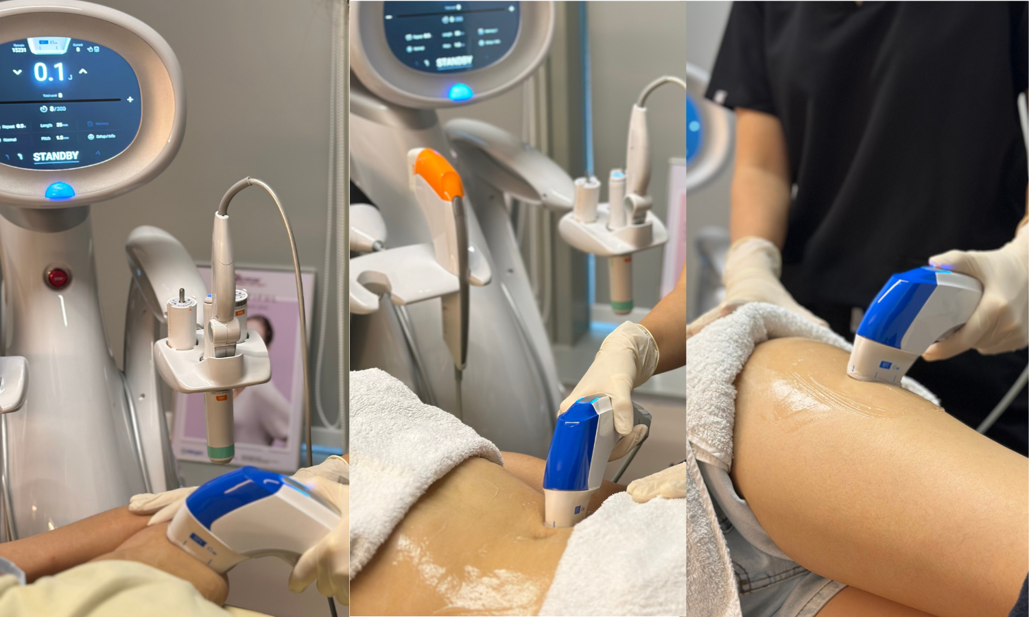 patient in hifu treatment