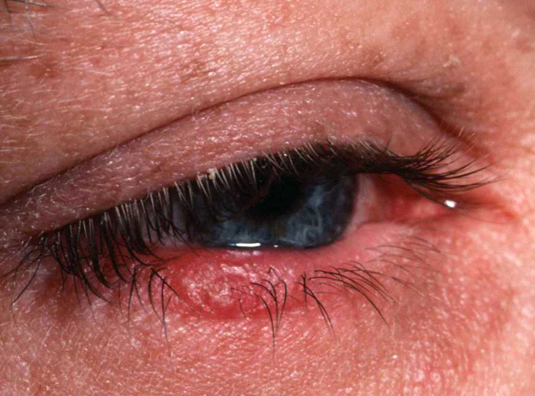 Eye irritation with Rosacea