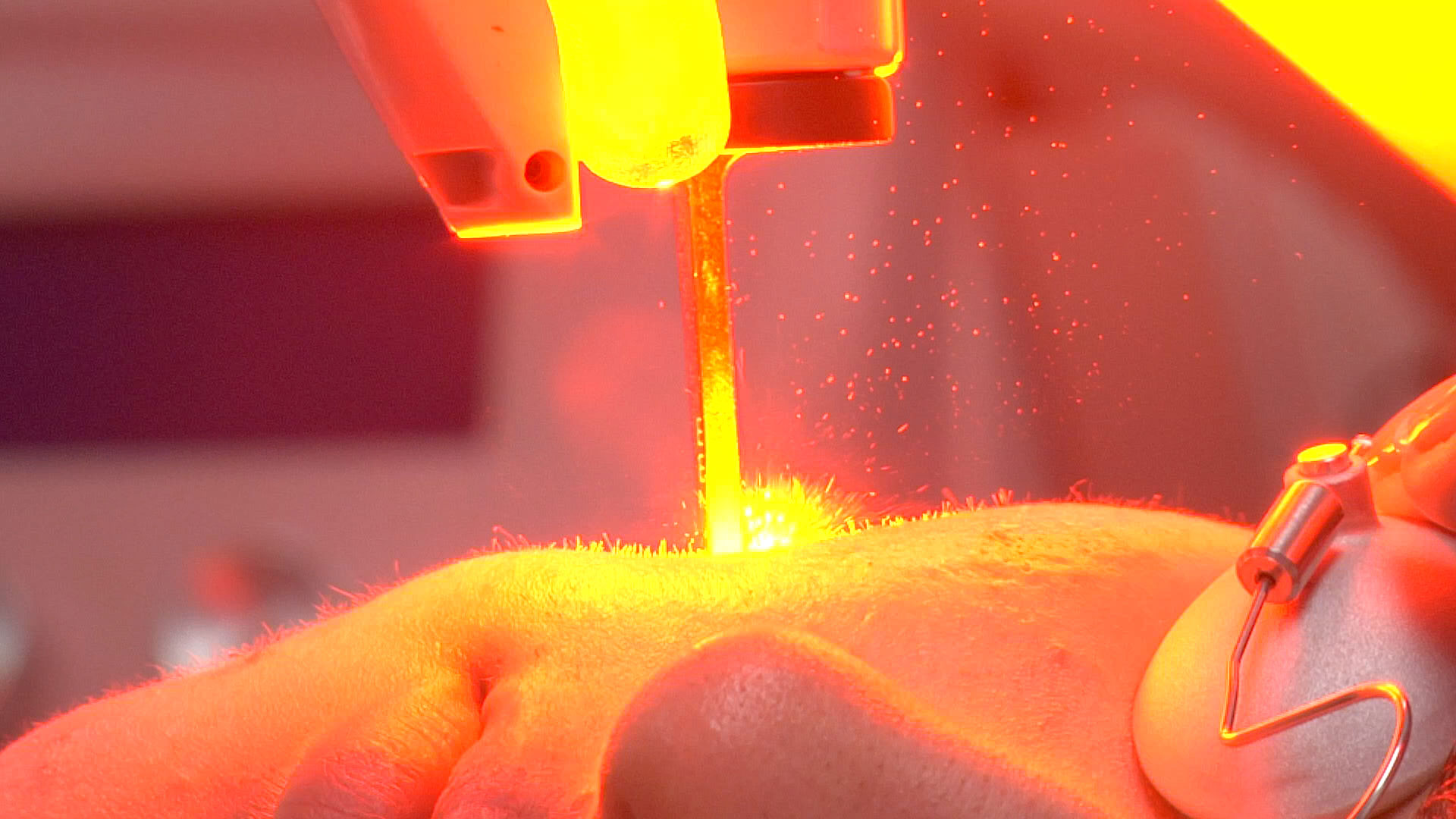 Laser therapy Treatment for rosacea