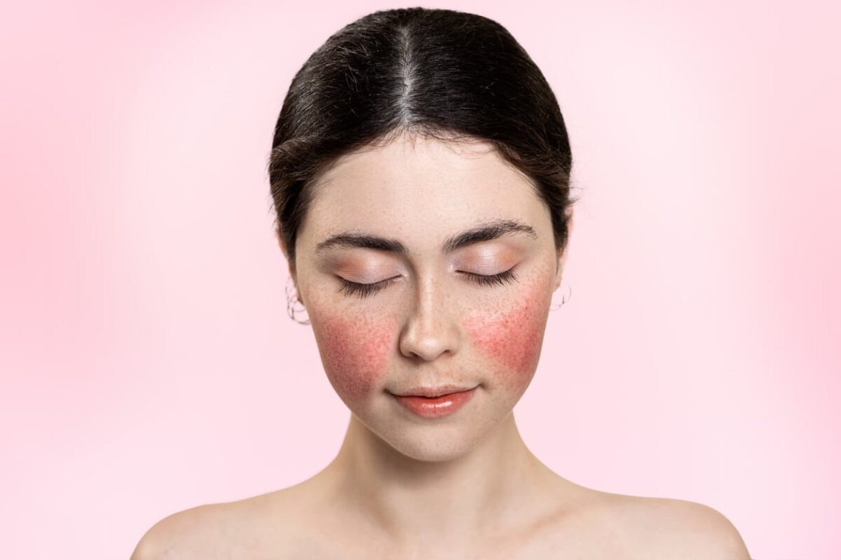Portrait of a beautiful woman with her eyes closed, showing inflamed blood vessels on her cheeks. Pink background. Copy space. Rosacea treatment concept.