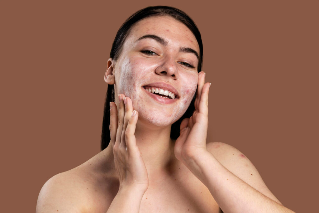 Beautiful woman showing her acne with confidence