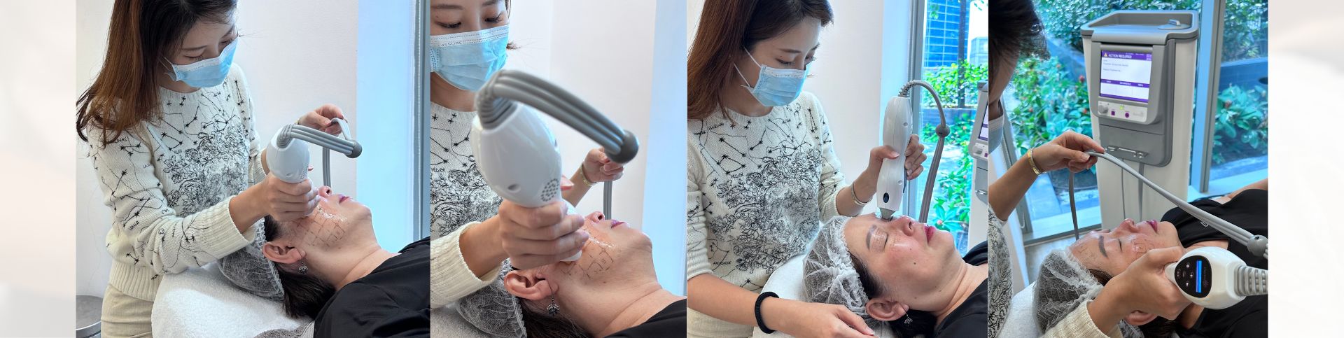 Thermage singapore treatment