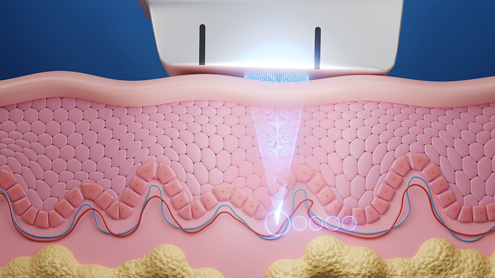 illustration for laser inside skin