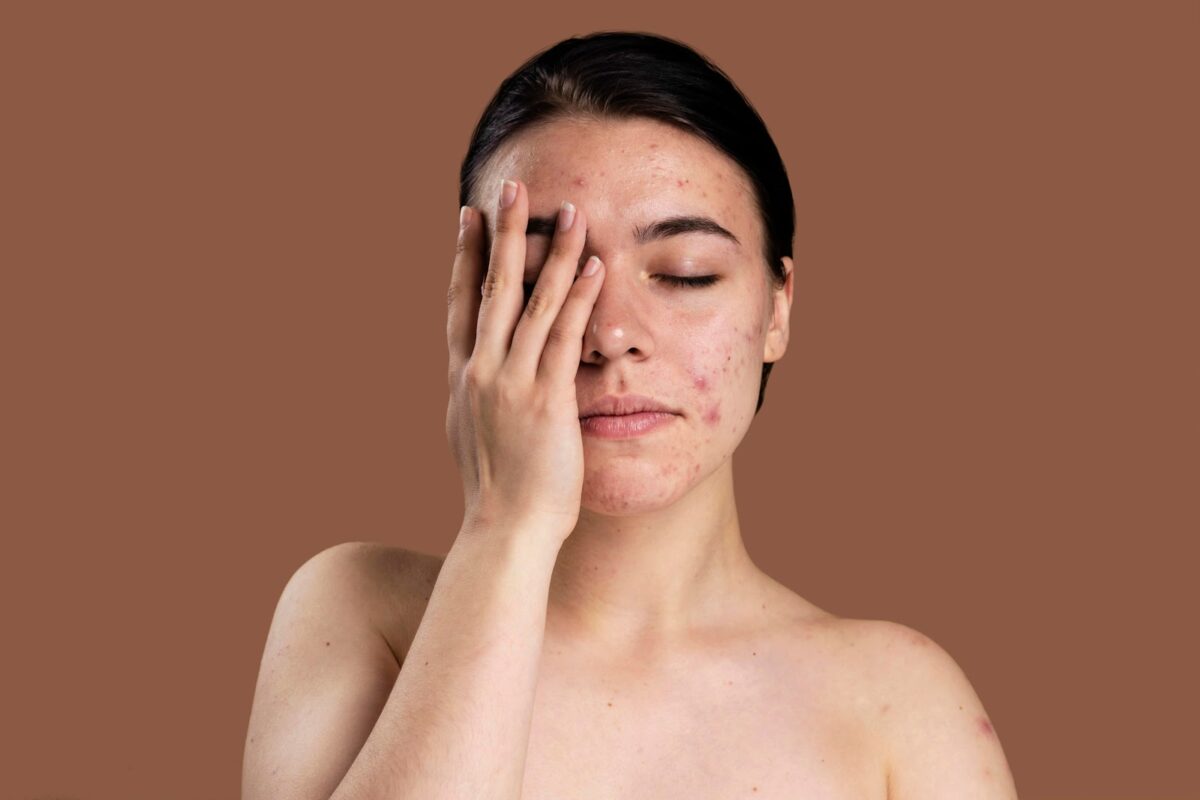 Woman with acne-prone skin covering half of her face