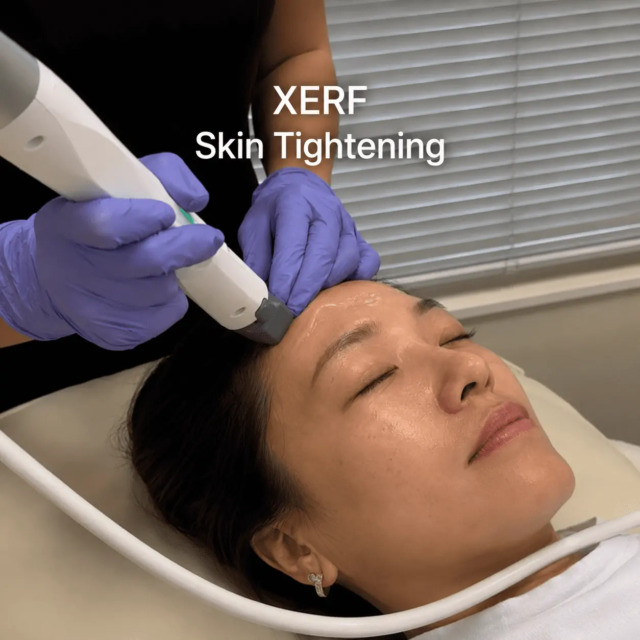 XERF Skin Tightening Singapore Lux Aesthetic Medical Clinic Singapore 4