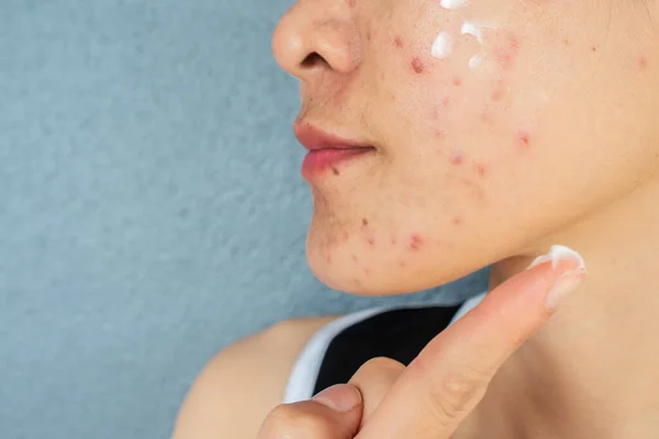 Close-up of woman applying cream on acne-prone skin for aesthetic treatment