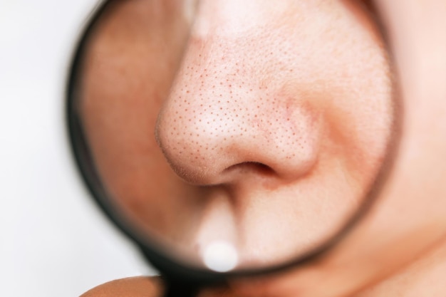 Blackheads: What is, Causes, Symptoms, 4 Treatments, and Prevention