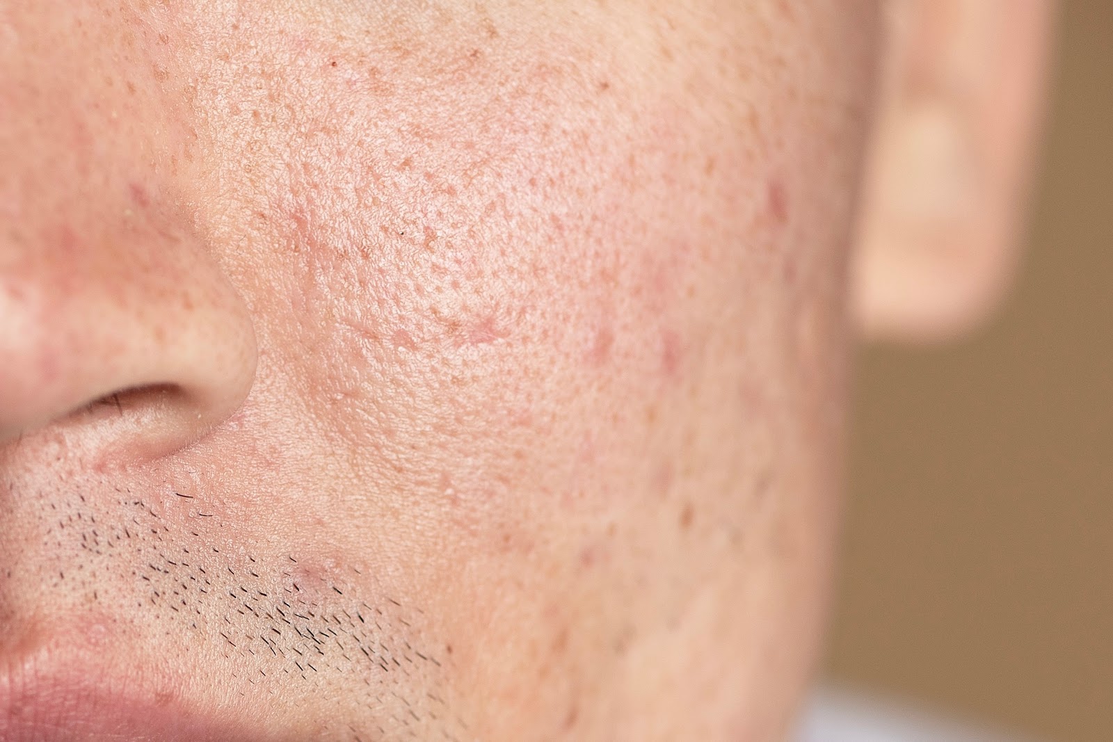 Boxcar Scars: What They Are, Causes and Treatment Options