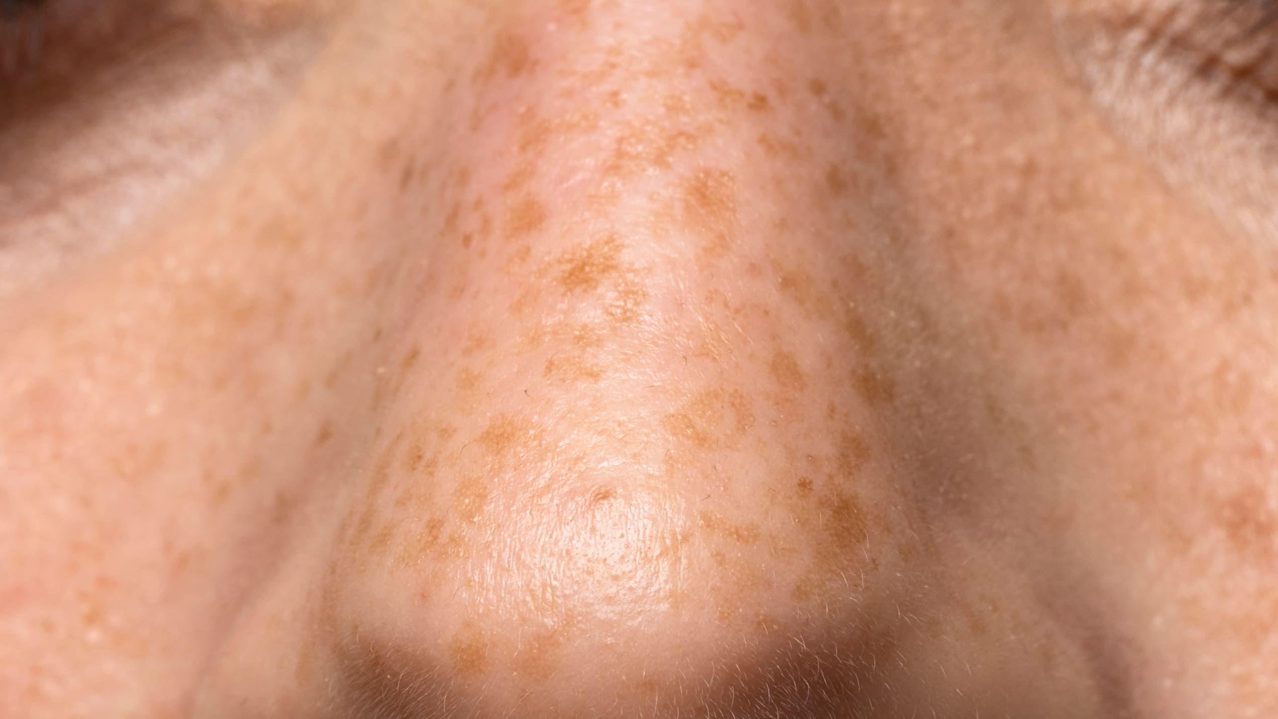 Sunspots (Solar Lentigines): Causes, Symptoms, & x Treatments