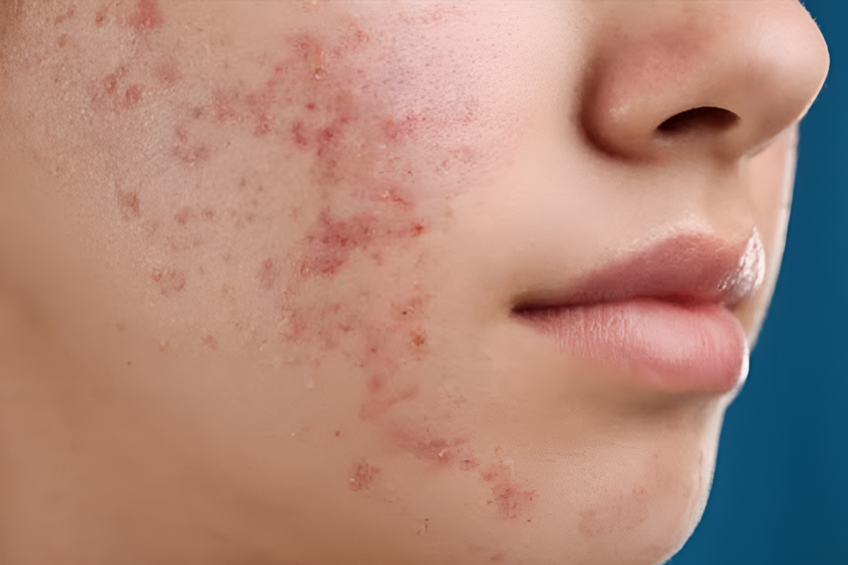 face with cystic acne