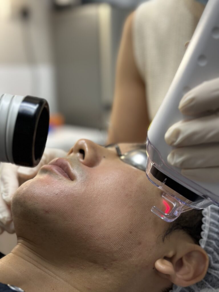 Male patient undergoing Fractional CO2 Laser treatment for acne scars