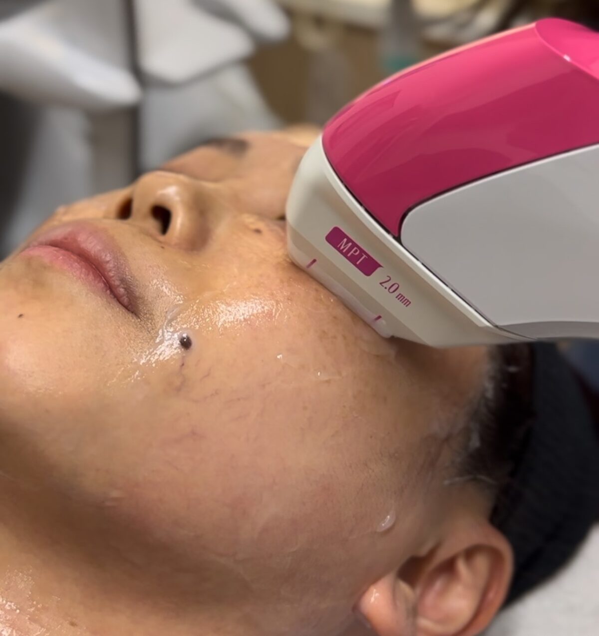 eye lift hifuu treatment