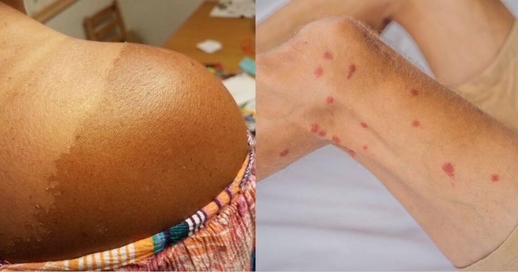 Post-inflammatory hyperpigmentation marks on arm with darker skin tone showing how discoloration appears across different ethnicities