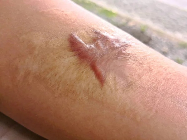 Keloid Scar: What Is It, Causes, Symptoms and Treatment Options