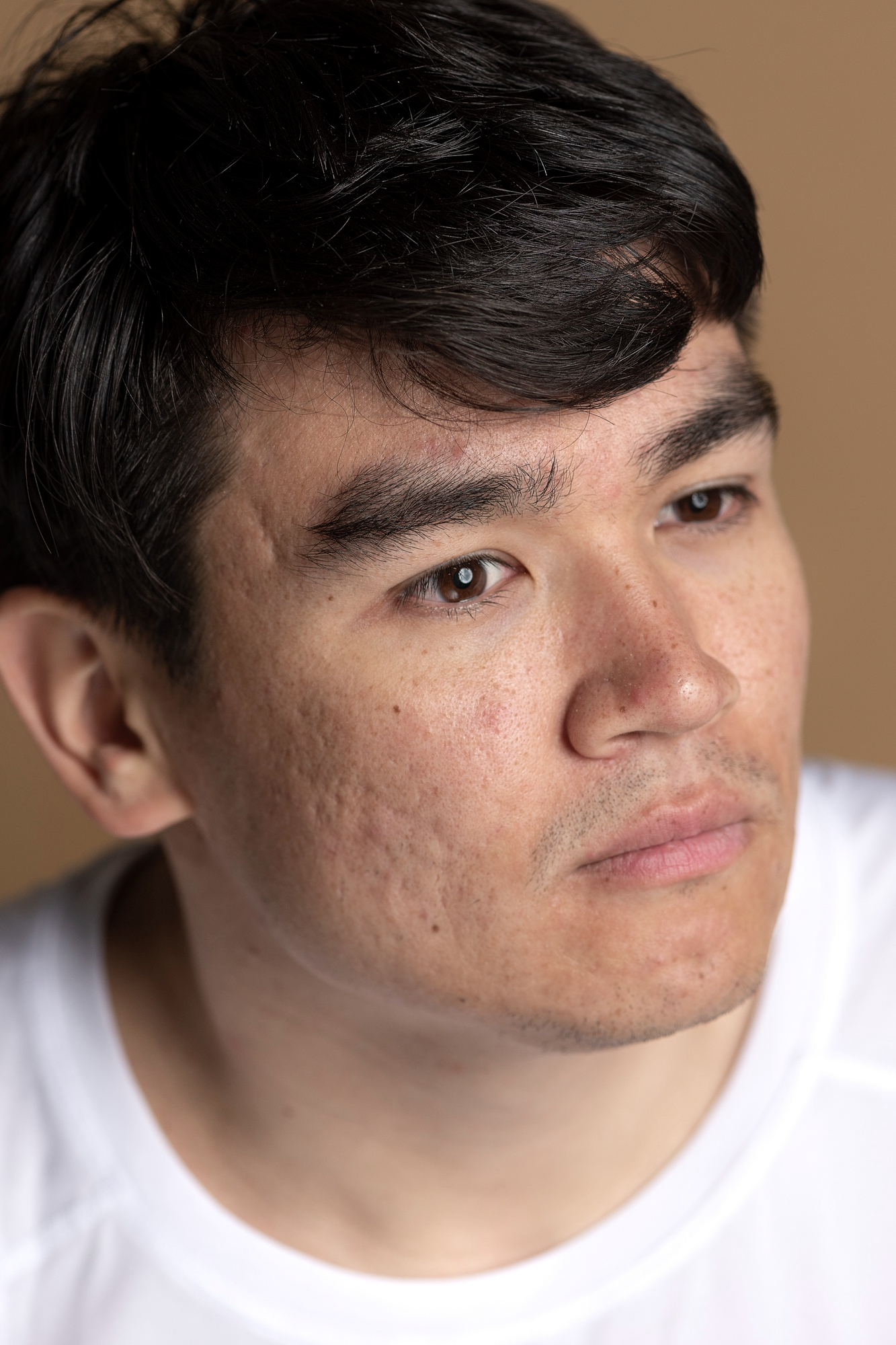 Close-up of a man's face showing visible acne scars on his cheeks
