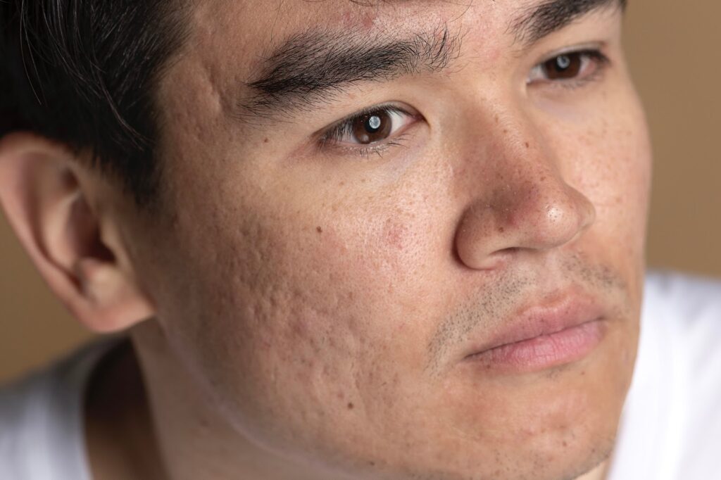close-up image of the face showing pitted acne scars
