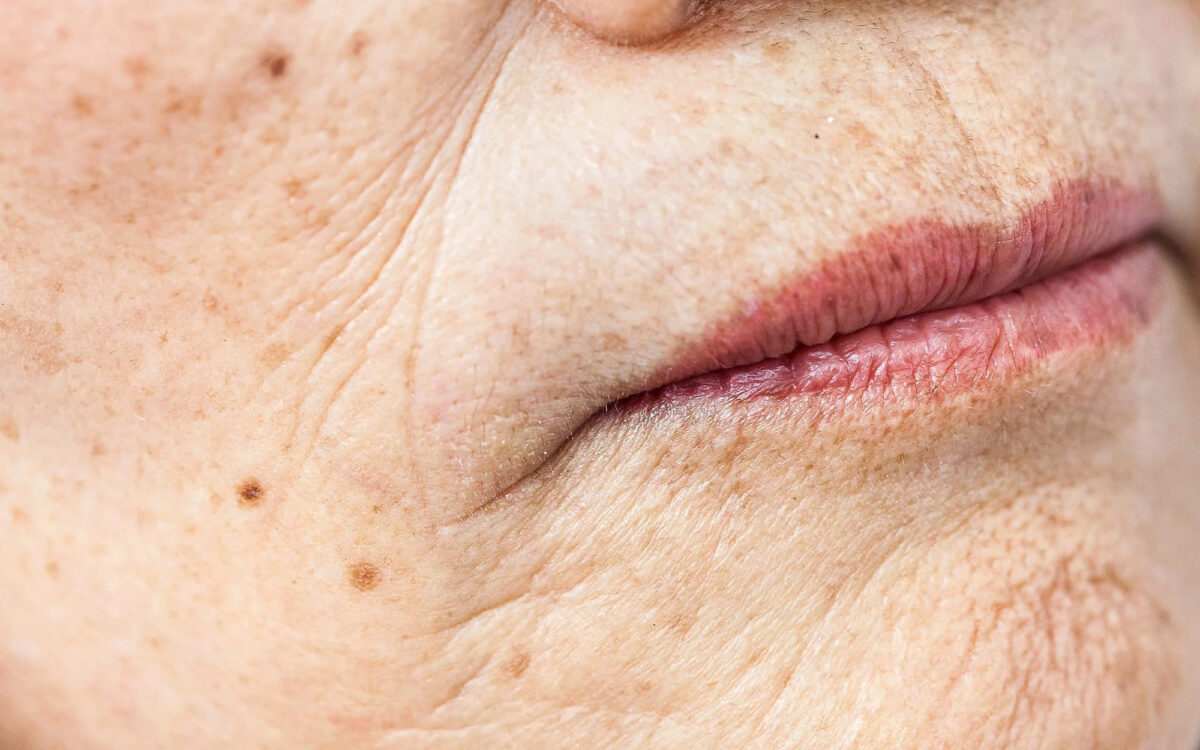 Close-up of wrinkles and marionette lines around an older woman’s mouth