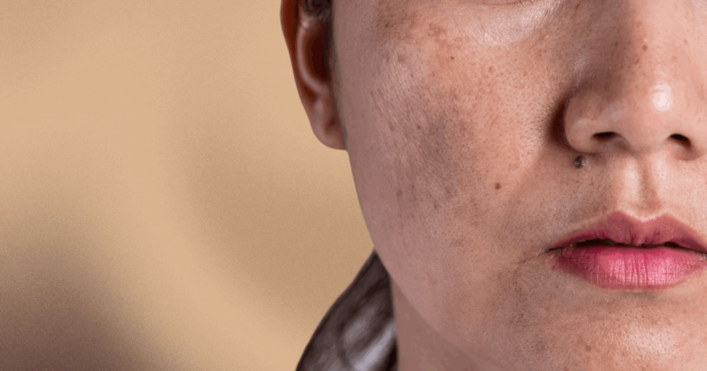 Close-up of woman with melasma