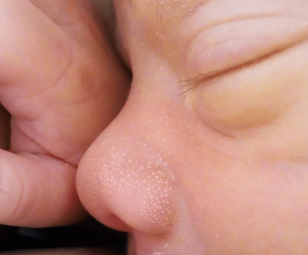 Newborn nose close-up showing small white bumps (possible milia)