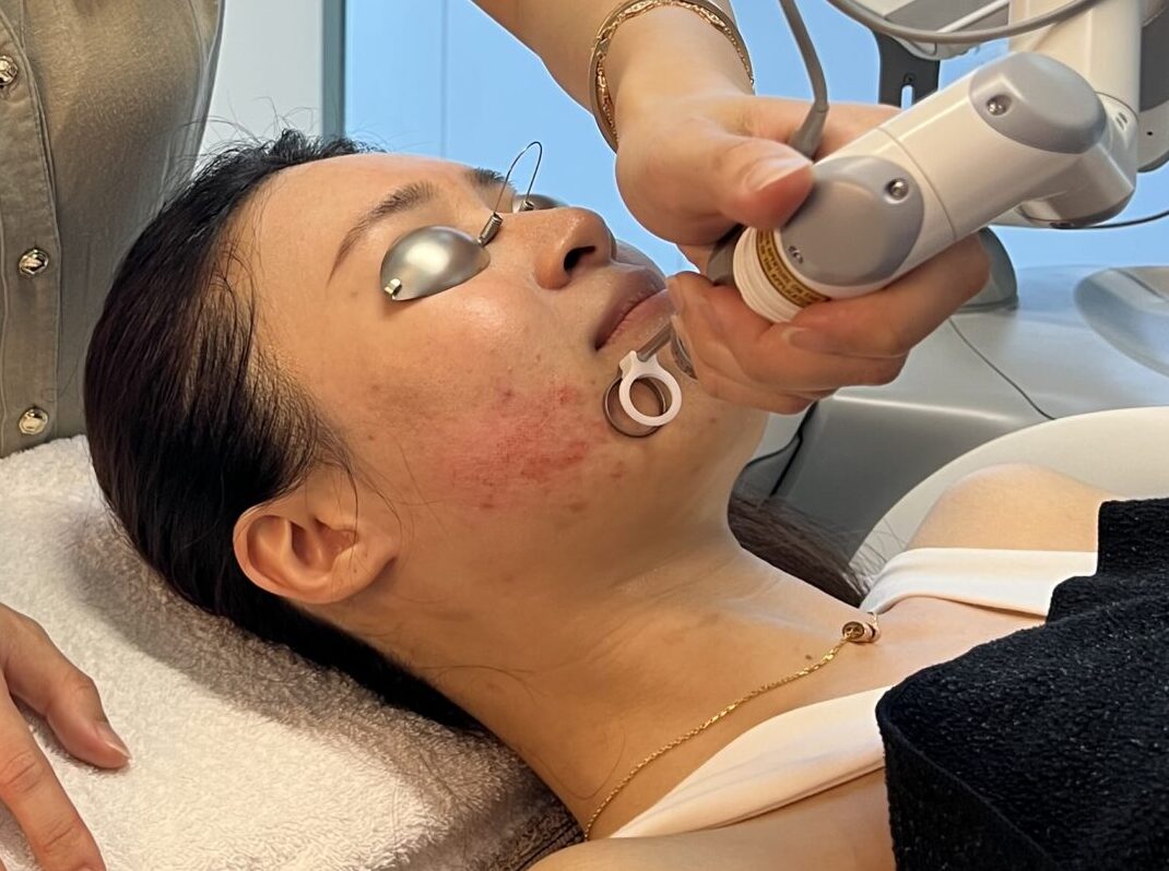 Pico Fractional Laser Treatment