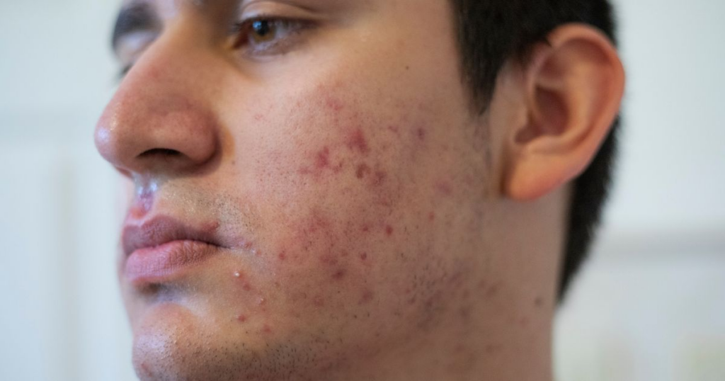 Post-inflammatory hyperpigmentation marks on male face caused by acne breakouts