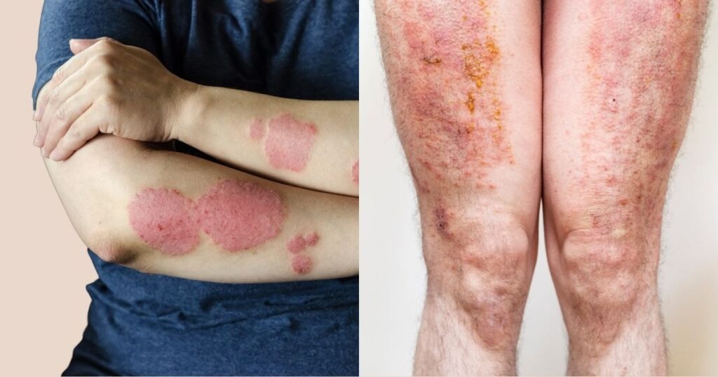 Comparison of post-inflammatory hyperpigmentation and scarring on arms showing different severity levels