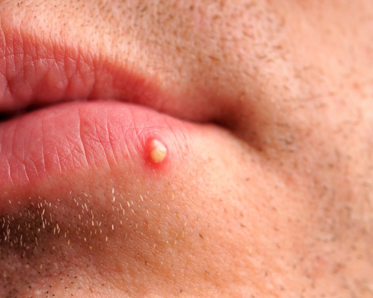 Close-up of pustule acne