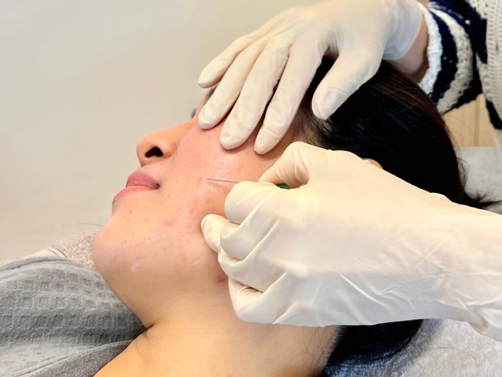 subcision treatment done for acne scar