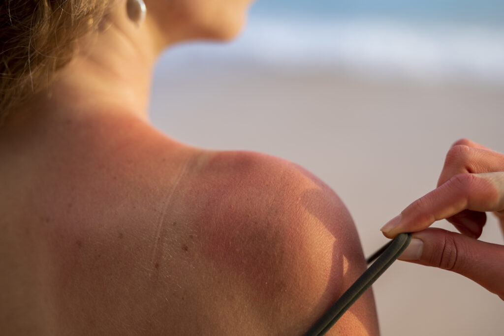 Close-up of a woman’s sunburned shoulder, highlighting skin redness and potential sunspots from sun exposure