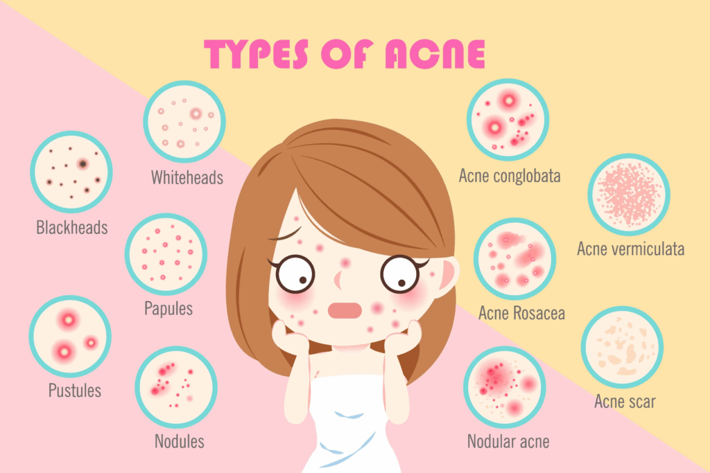 types of acne
