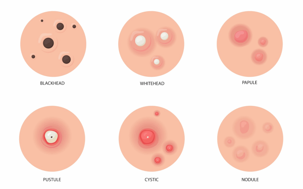 Illustration showing different types of acne including blackheads, whiteheads, papules, pustules, cystic acne, and nodules