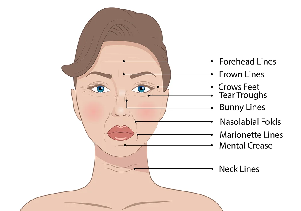 Illustration showing different types of facial lines and wrinkles including forehead lines, crow’s feet, nasolabial folds, and marionette lines