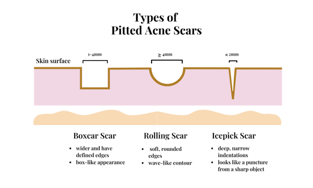 types of pitted acne scars