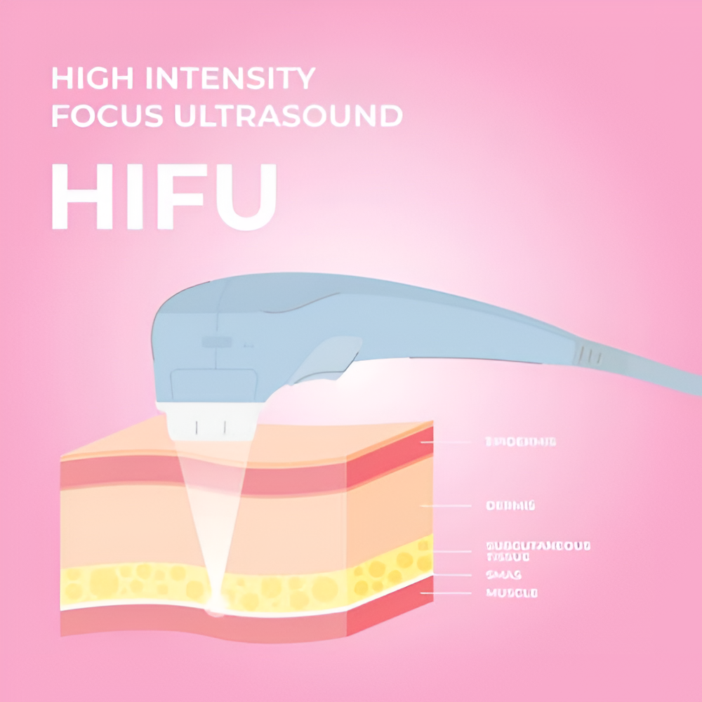 HIFU illustration