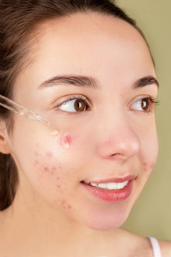 applying skin care product into the skin with acne
